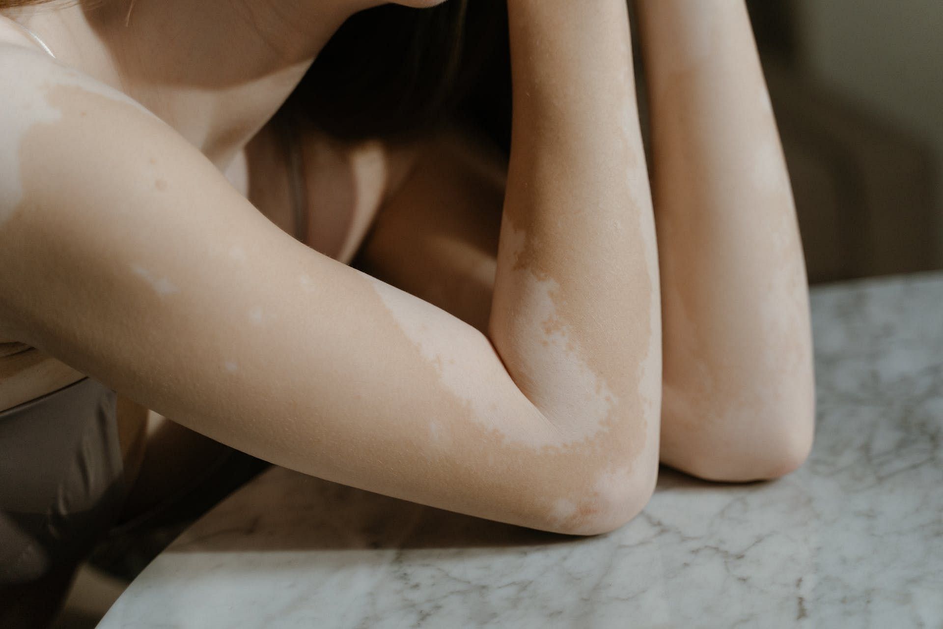 Vitiligo (Image via Pexels/Ron Lach)